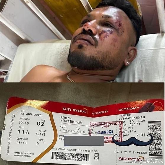 인도 여객기 추락사고의 유일한 생존자가 치료를 받고 있다. (사진=웨이보 캡처/연합뉴스)